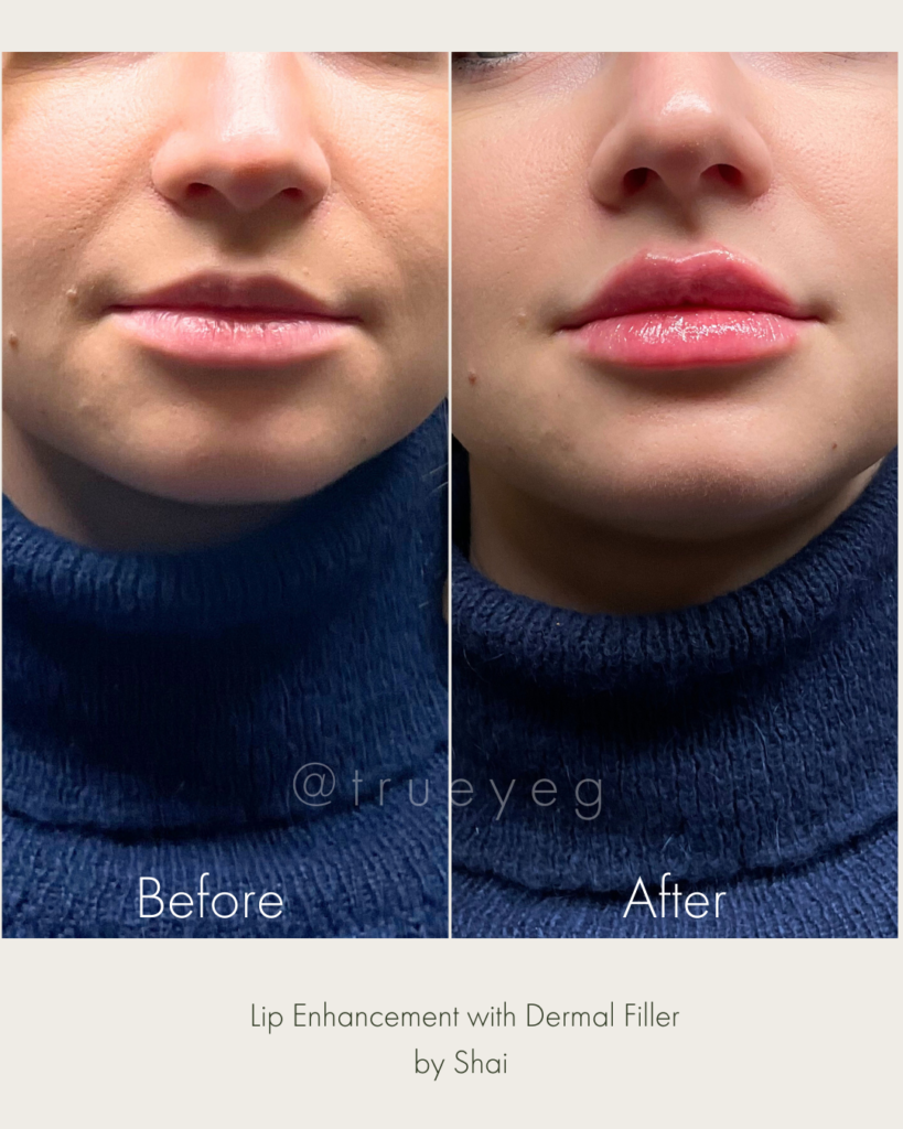 After: Lip Enhancement