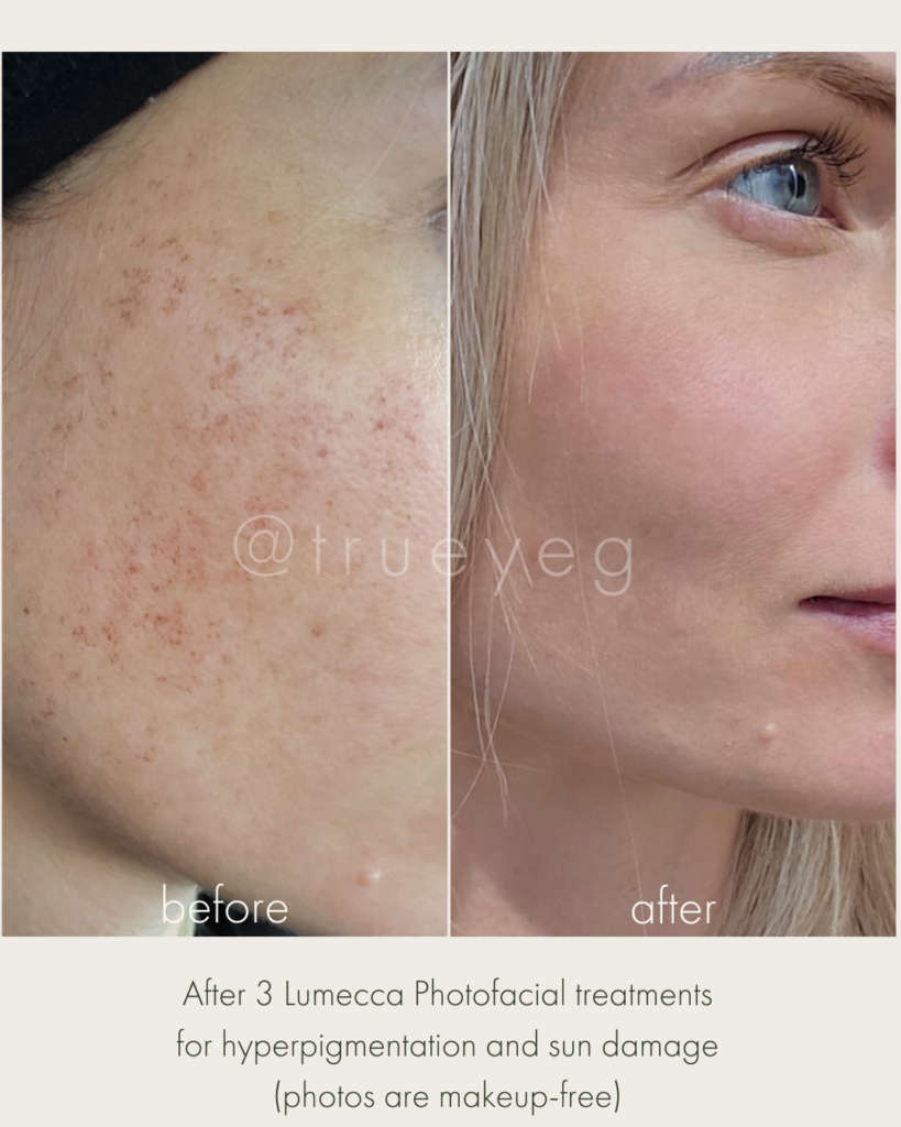 After: Lumecca Photofacial to treat hyperpigmentation and sun damage