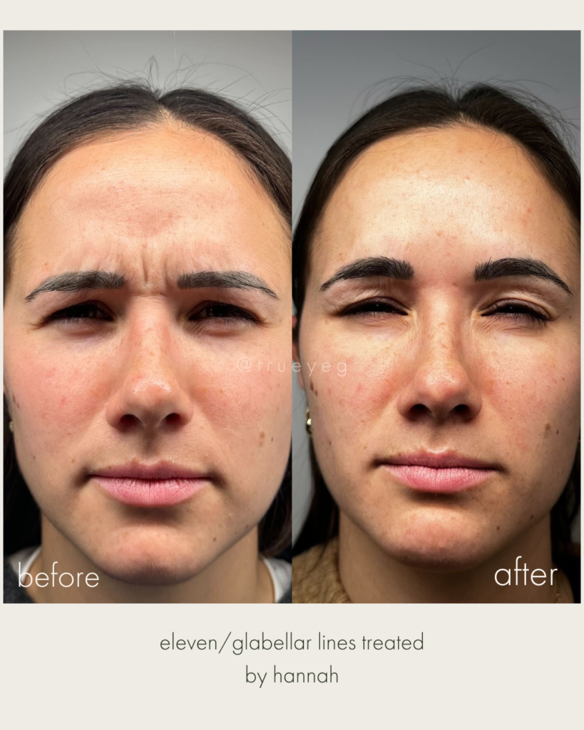 Before and after Botox Treatment for eleven lines