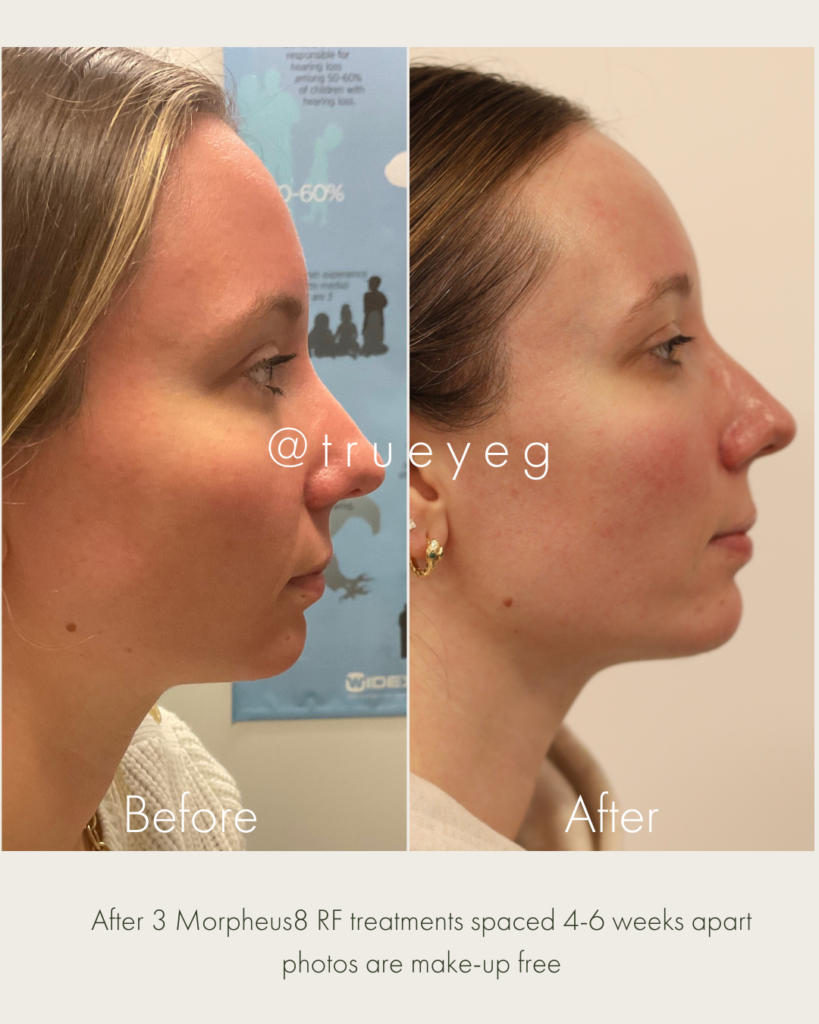 before and after 3 morpheus8 rf treatments