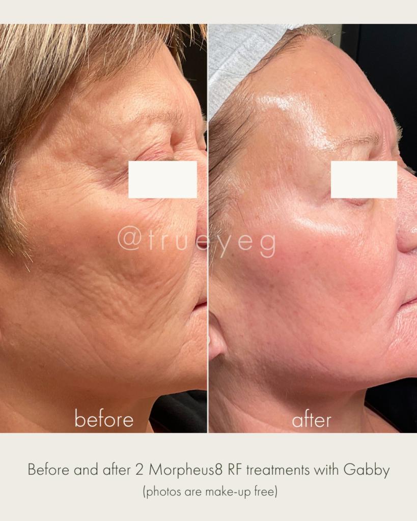 before and after 2 morpheus7 rf treatments