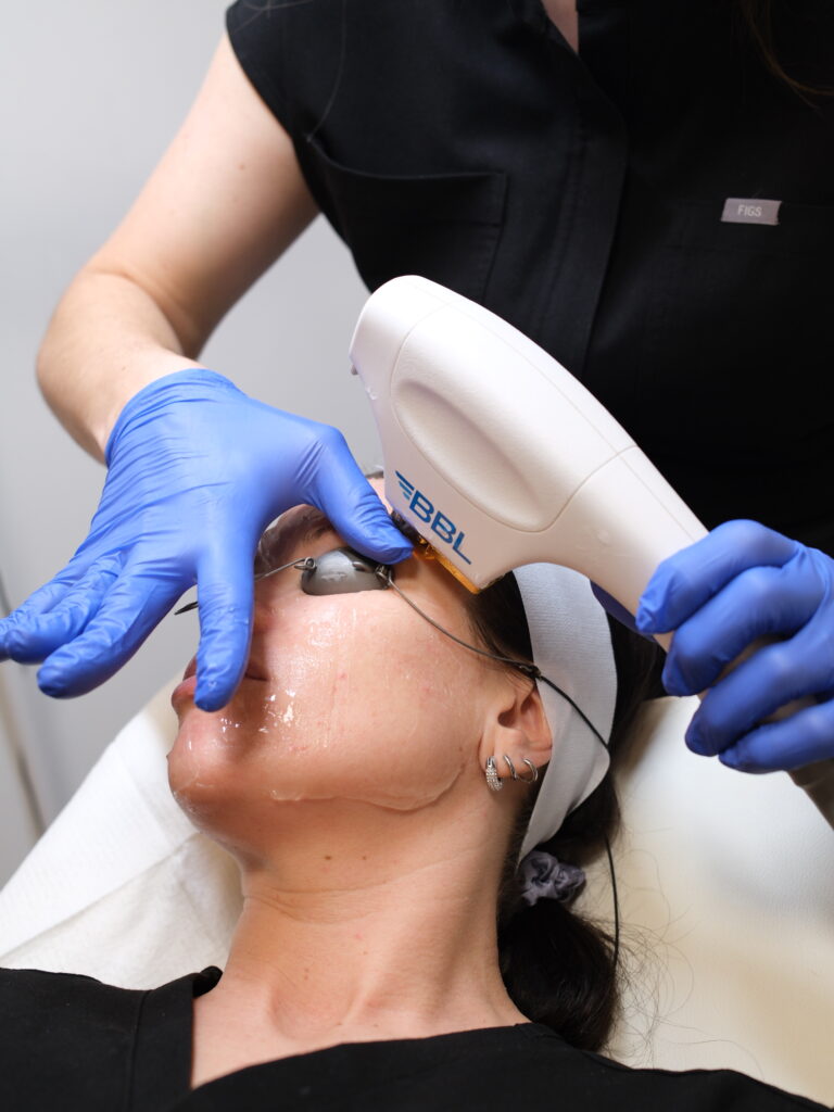 BBL Treatment at True YEG