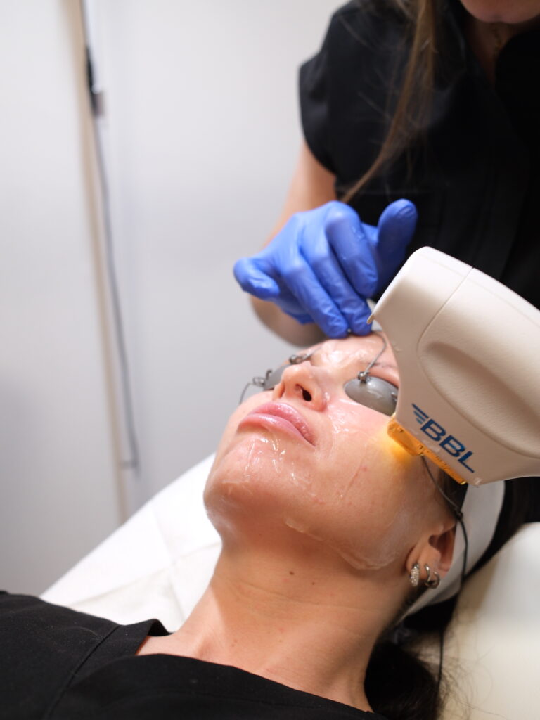 BBL Treatment at True Aesthetics YEG